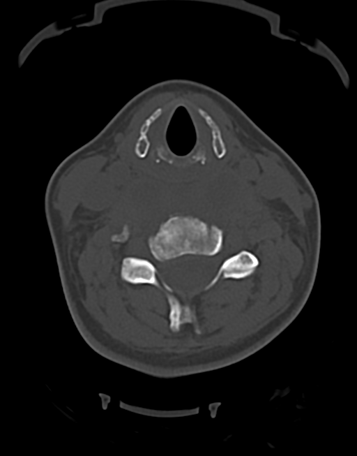 Cervical tuberculous spondylitis (Radiopaedia 39149-41365 Axial bone window 29).png