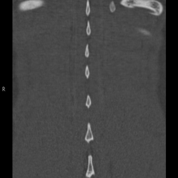 File:Chance fracture (Radiopaedia 36521-38081 Coronal bone window 61).jpg