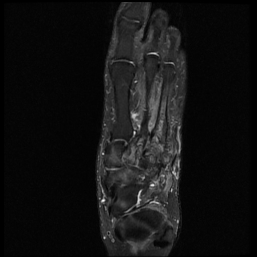 File:Charcot arthropathy (Radiopaedia 55056-61422 Axial PD fat sat 14).jpg