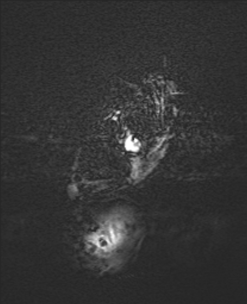 Chiari III malformation with occipital encephalocele (Radiopaedia 79446-92559 Axial SWI 3).jpg