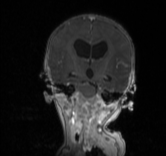 Chiari III malformation with occipital encephalocele (Radiopaedia 79446-92559 Coronal T1 C+ mpr 16).jpg