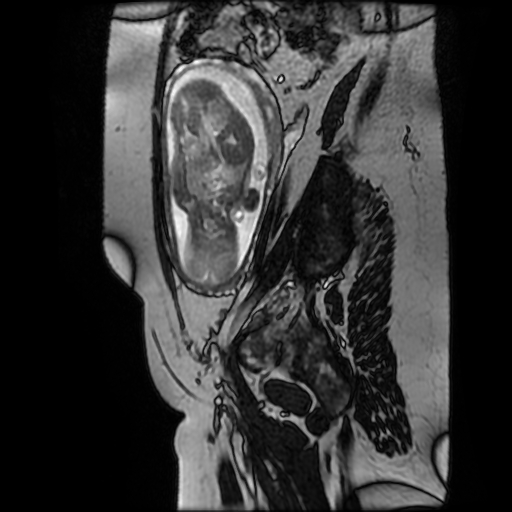 Chiari II malformation - fetal MRI (Radiopaedia 68099-77581 Sagittal Fiesta 14).jpg