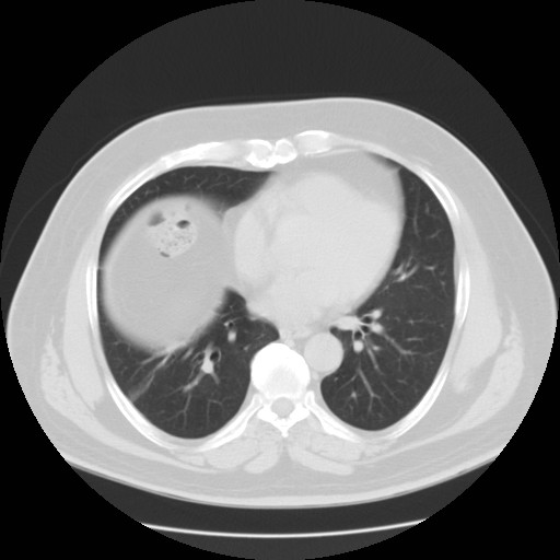 File:Chilaiditi’s syndrome (Radiopaedia 27550-27756 Axial lung window 6).jpg