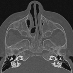 Choanal atresia (Radiopaedia 88525-105975 Axial bone window 36).jpg