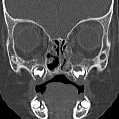 Choanal atresia (Radiopaedia 88525-105975 Coronal bone window 39).jpg