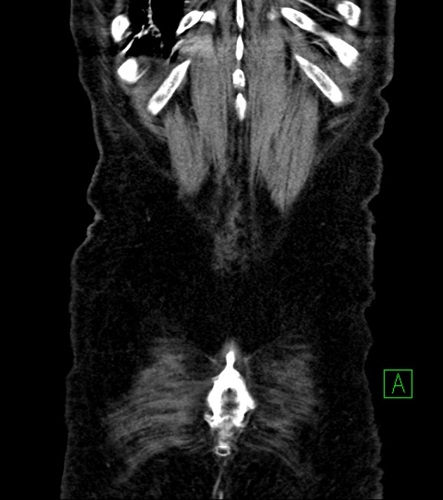 Cholangiocarcinoma with cerebral metastases (Radiopaedia 83519-98629 E 81).jpg