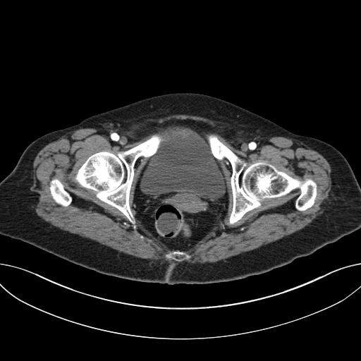 Cholecystoduodenal fistula due to calculous cholecystitis with gallstone migration (Radiopaedia 86875-103077 A 71).jpg