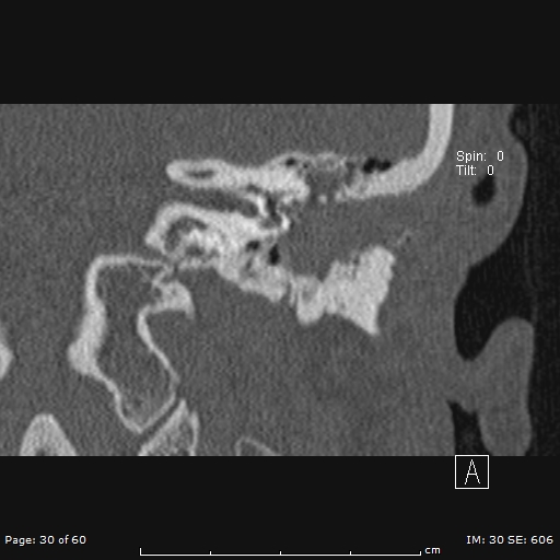 Cholesteatoma - external auditory canal (Radiopaedia 88452-105096 Coronal bone window 30).jpg