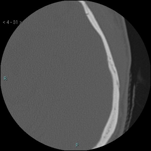 Cholesterol granuloma of the petrous apex (Radiopaedia 64358-73141 Axial bone window 15).jpg