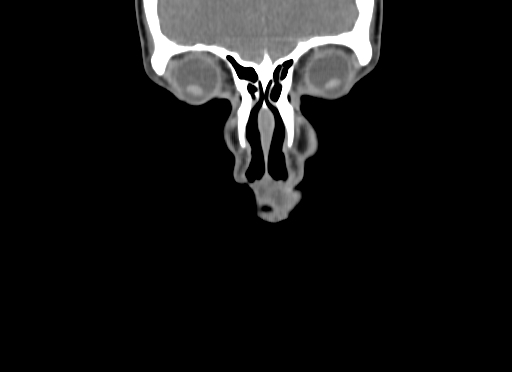 Chondroblastic osteosarcoma (Radiopaedia 67363-76741 D 10).jpg