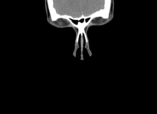 Chondroblastic osteosarcoma (Radiopaedia 67363-76741 D 4).jpg