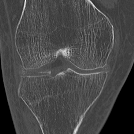Chondrocalcinosis (Radiopaedia 16275-15955 Coronal bone window 28).jpg