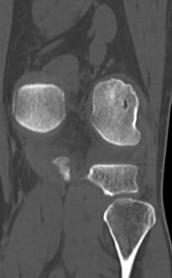 Chondrocalcinosis (Radiopaedia 82862-97173 Coronal bone window 61).jpg