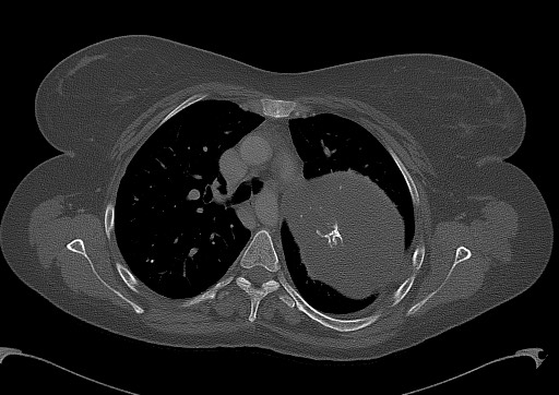 Chondrosarcoma - chest wall (Radiopaedia 65192-74199 Axial bone window 47).jpg