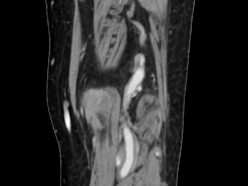 Chondrosarcoma - femur (Radiopaedia 64187-72954 C 50).jpg