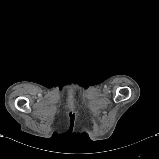 Chondrosarcoma of the spine (Radiopaedia 49871-55143 A 71).jpg