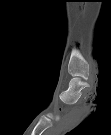 Chopart fracture (Radiopaedia 35347-36851 Sagittal bone window 22).jpg