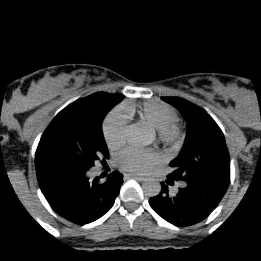 File:Choriocarcinoma of ovary with cerebral and pulmonary metastases (Radiopaedia 25983-26119 Axial non-contrast 139).jpg