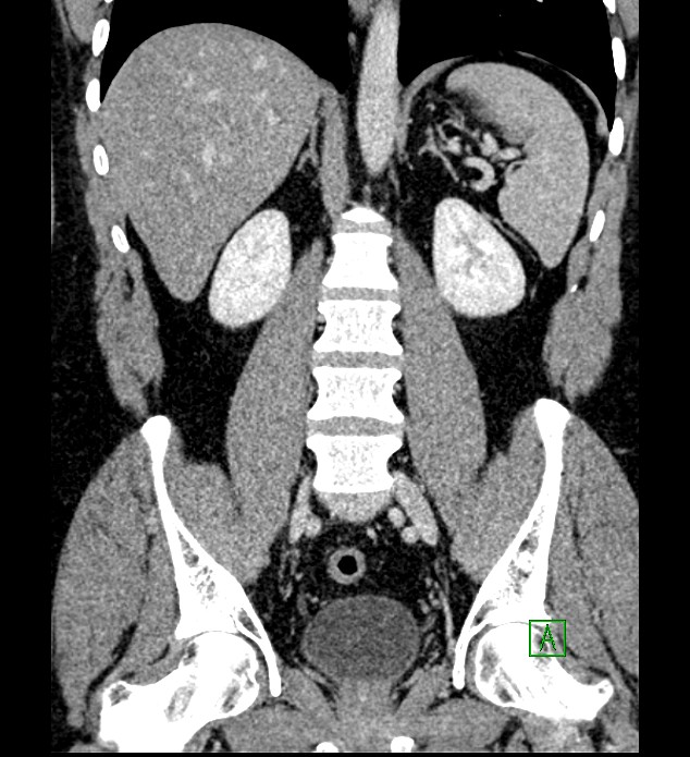 Chromophobe renal cell carcinoma (Radiopaedia 84286-99573 H 114).jpg