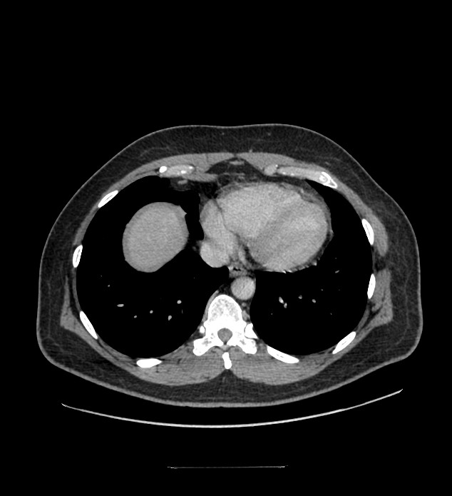 Chromophobe renal cell carcinoma (Radiopaedia 84337-99644 C 10).jpg
