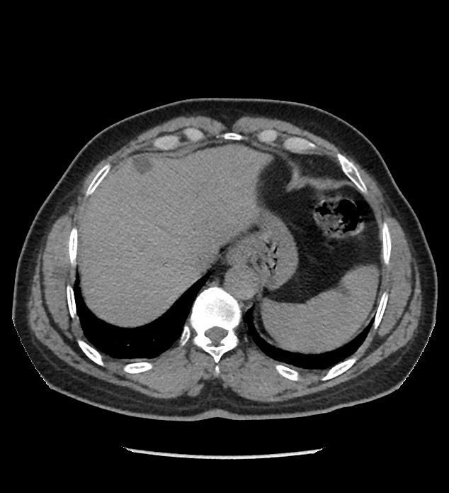 Chromophobe renal cell carcinoma (Radiopaedia 86879-103083 Axial non-contrast 3).jpg