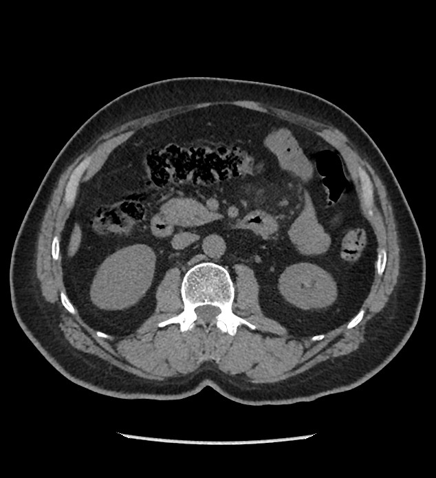 Chromophobe renal cell carcinoma (Radiopaedia 86879-103083 Axial non-contrast 42).jpg