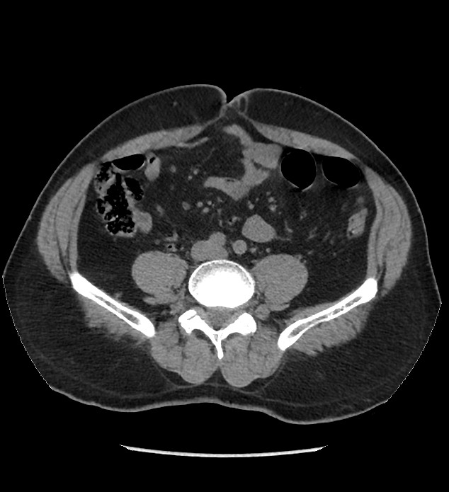 Chromophobe renal cell carcinoma (Radiopaedia 86879-103083 Axial non-contrast 76).jpg