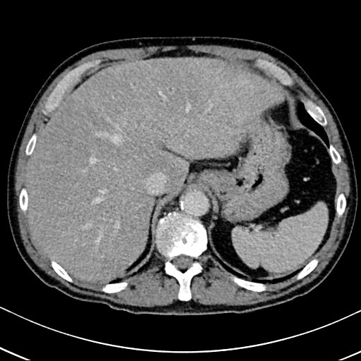 Chronic appendicitis complicated by appendicular abscess, pylephlebitis and liver abscess (Radiopaedia 54483-60700 B 37).jpg