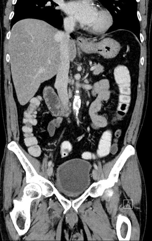 Chronic appendicitis complicated by appendicular abscess, pylephlebitis and liver abscess (Radiopaedia 54483-60700 C 40).jpg
