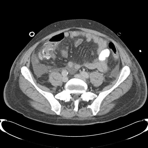 Chronic diverticulitis complicated by hepatic abscess and portal vein thrombosis (Radiopaedia 30301-30938 A 66).jpg