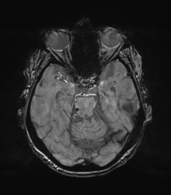 Chronic hypertensive encephalopathy (Radiopaedia 72844-83495 Axial SWI magnitude 29).png