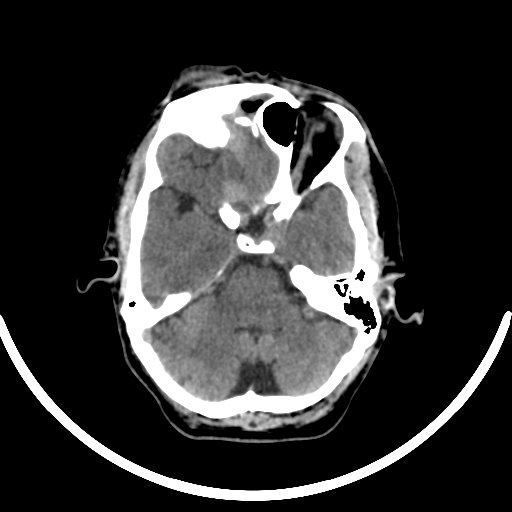 Chronic invasive fungal sinusitis with intraorbital and intracranial extension (Radiopaedia 56387-63046 Axial non-contrast 141).jpg
