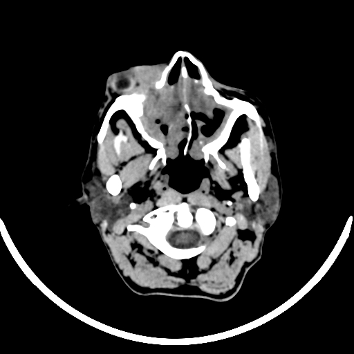 File:Chronic invasive fungal sinusitis with intraorbital and intracranial extension (Radiopaedia 56387-63046 Axial non-contrast 65).jpg