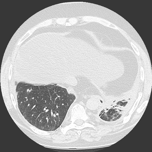 Chronic lung allograft dysfunction - restrictive form (Radiopaedia 60595-68316 Axial lung window 55).jpg