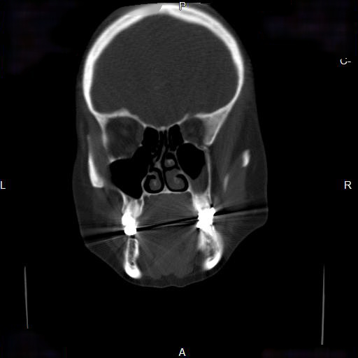 File:Chronic maxillary sinusitis with a foreign body (dental filling material) (Radiopaedia 7811-8639 Coronal bone window 7).jpg