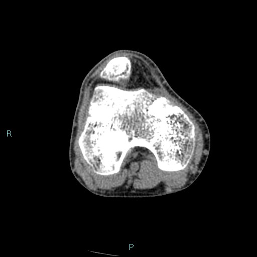 Chronic osteomyelitis (with Brodie abscess) (Radiopaedia 76405-88111 A 135).jpg