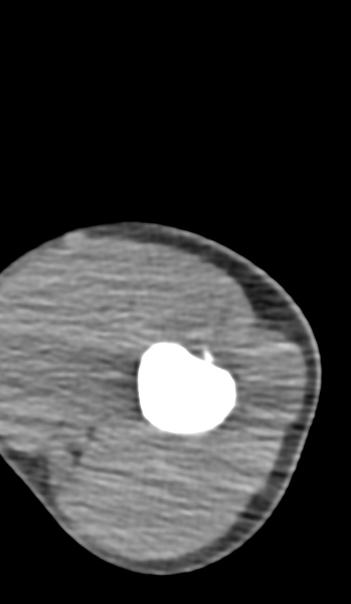 Chronic osteomyelitis of the distal humerus (Radiopaedia 78351-90971 Axial non-contrast 50).jpg