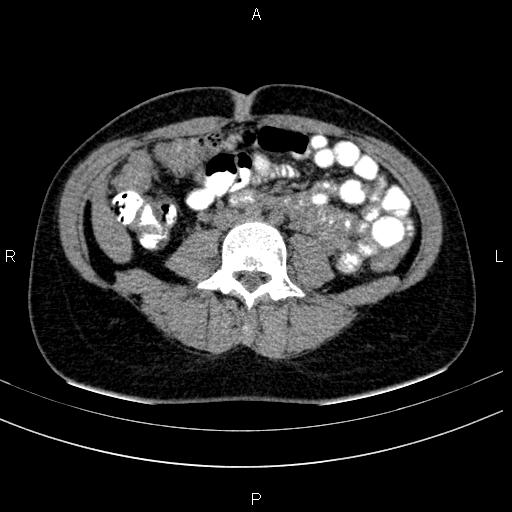 File:Chronic pancreatitis (Radiopaedia 64576-73450 Axial non-contrast 94).jpg