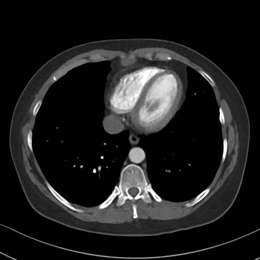 File:Chronic pulmonary embolus (Radiopaedia 39129-41341 Axial C+ CTPA 75).png