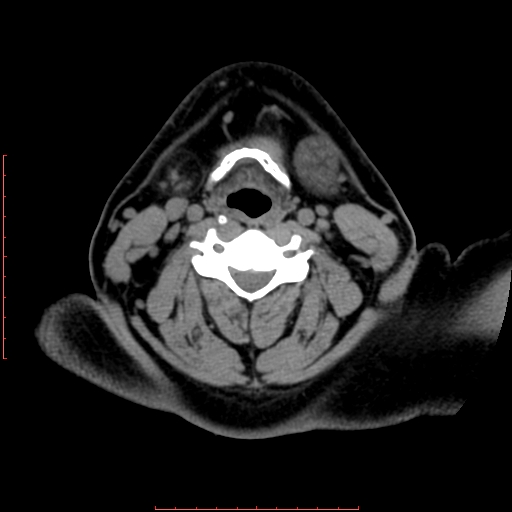 Chronic submandibular sialolithiasis (Radiopaedia 69817-79814 Axial non-contrast 147).jpg