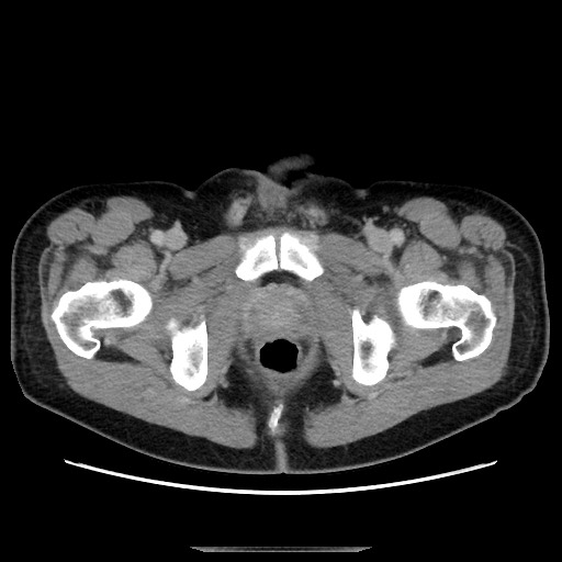 File:Chronic ureteropelvic junction obstruction (Radiopaedia 78365-90996 A 134).jpg