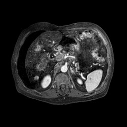 Cirrhosis and hepatocellular carcinoma in the setting of hemochromatosis (Radiopaedia 75394-86594 Axial T1 C+ fat sat 213).jpg