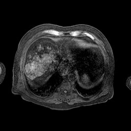 Cirrhosis and hepatocellular carcinoma in the setting of hemochromatosis (Radiopaedia 75394-86594 Axial T1 C+ fat sat 67).jpg