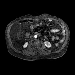 Cirrhosis and hepatocellular carcinoma in the setting of hemochromatosis (Radiopaedia 75394-86594 Axial T1 C+ fat sat 93).jpg