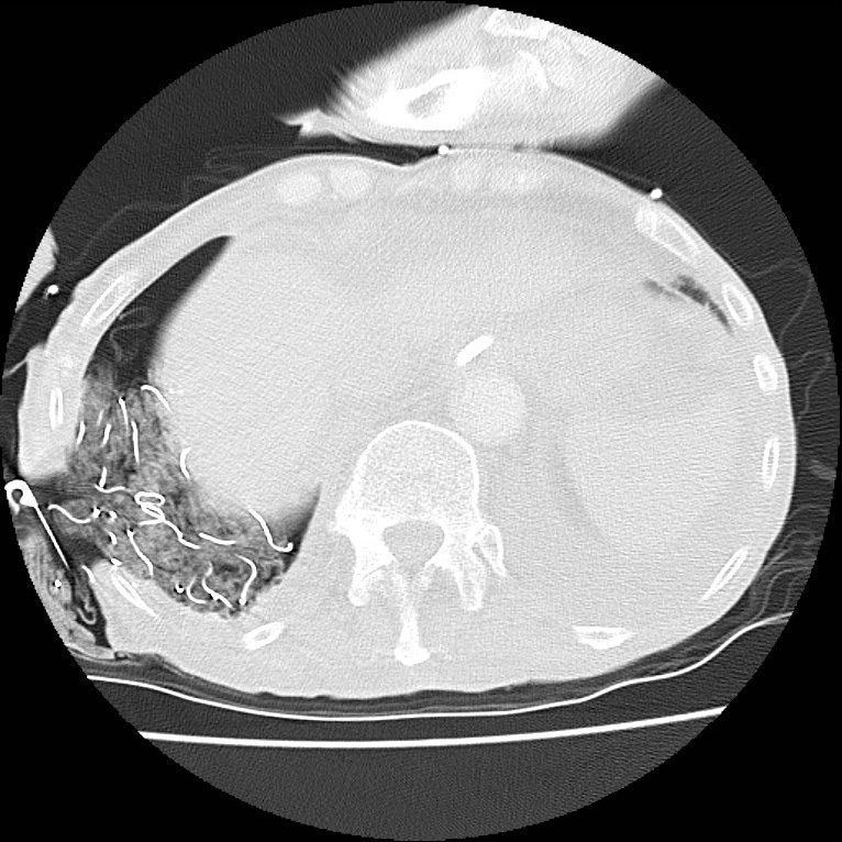 Clagett thoracotomy with bronchopleural fistula (Radiopaedia 29192-29587 Axial lung window 45).jpg