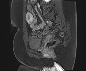 File:Class II Mullerian duct anomaly- unicornuate uterus with rudimentary horn and non-communicating cavity (Radiopaedia 39441-41755 G 40).jpg