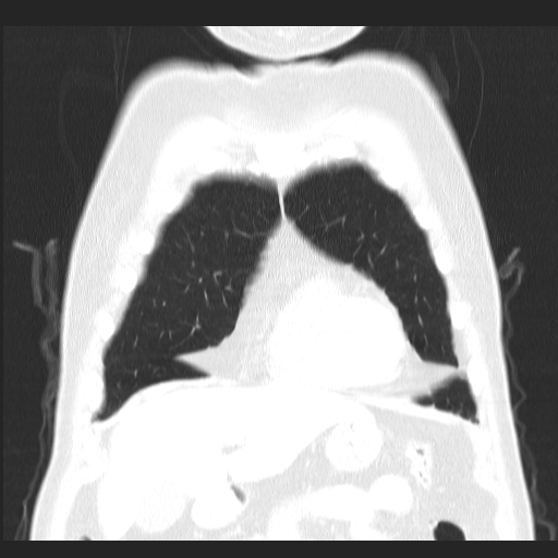 File:Classic complicated silicosis (Radiopaedia 49720-54961 Coronal lung window 10).jpg