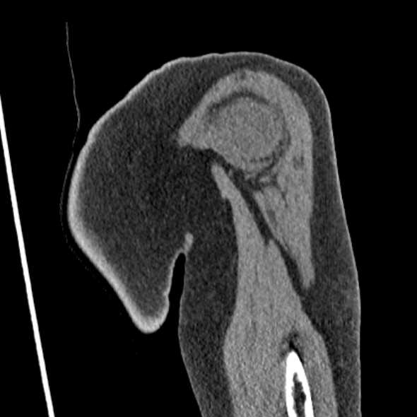 Clear cell chondrosarcoma - humerus (Radiopaedia 63104-71612 Coronal non-contrast 10).jpg