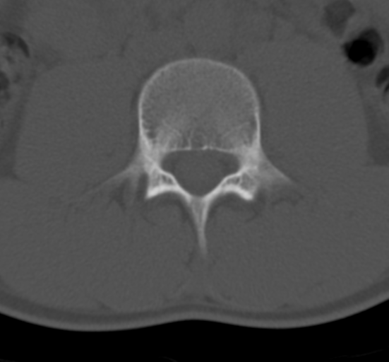 Clear cell meningoma - lumbar spine (Radiopaedia 60116-67691 Axial bone window 39).png