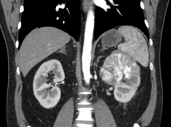 File:Clear cell renal cell carcinoma (Radiopaedia 61449-69393 C 25).jpg